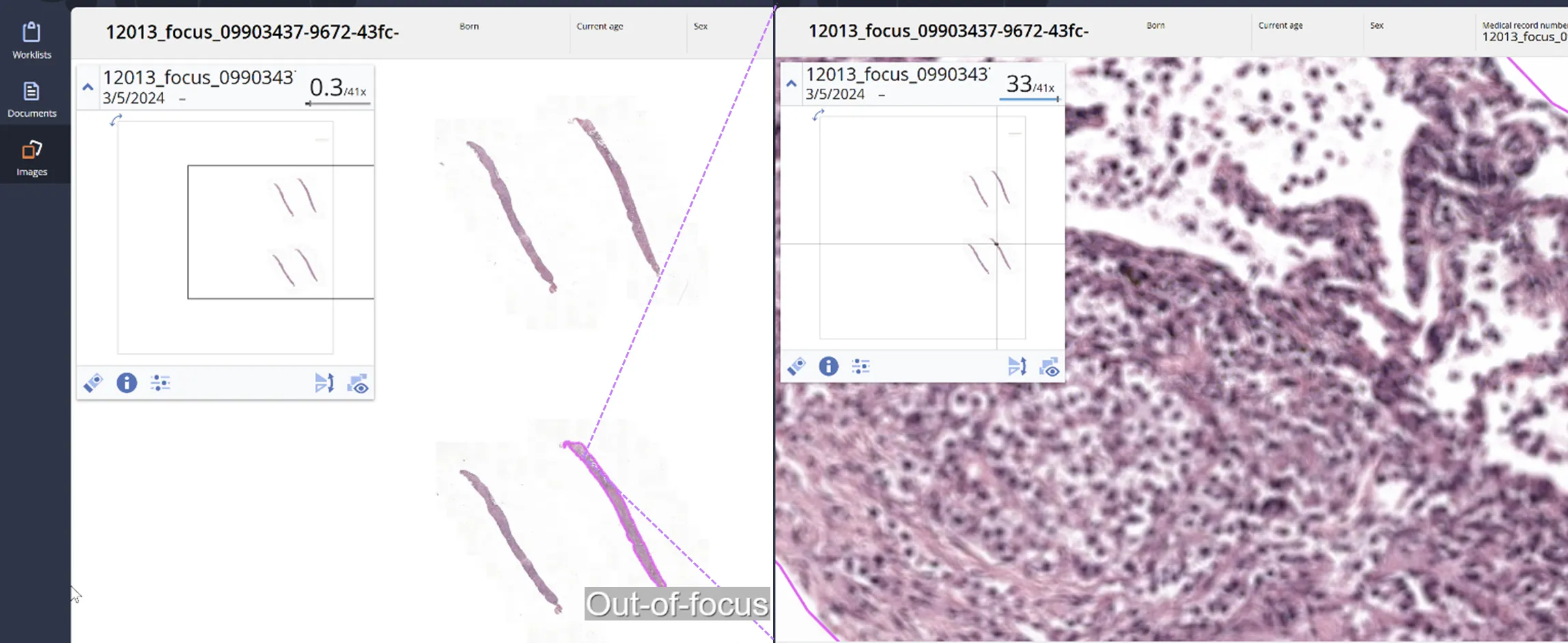 Automated quality control AI output by AiosynQC segmenting out-of-focus regions in an H&E digital histology slide. Left: whole slide image at low magnification with four visible tissue sections, one of them highlighted by AiosynQC. Right: Zoom-in of the segmented region, very visibly out of focus.
