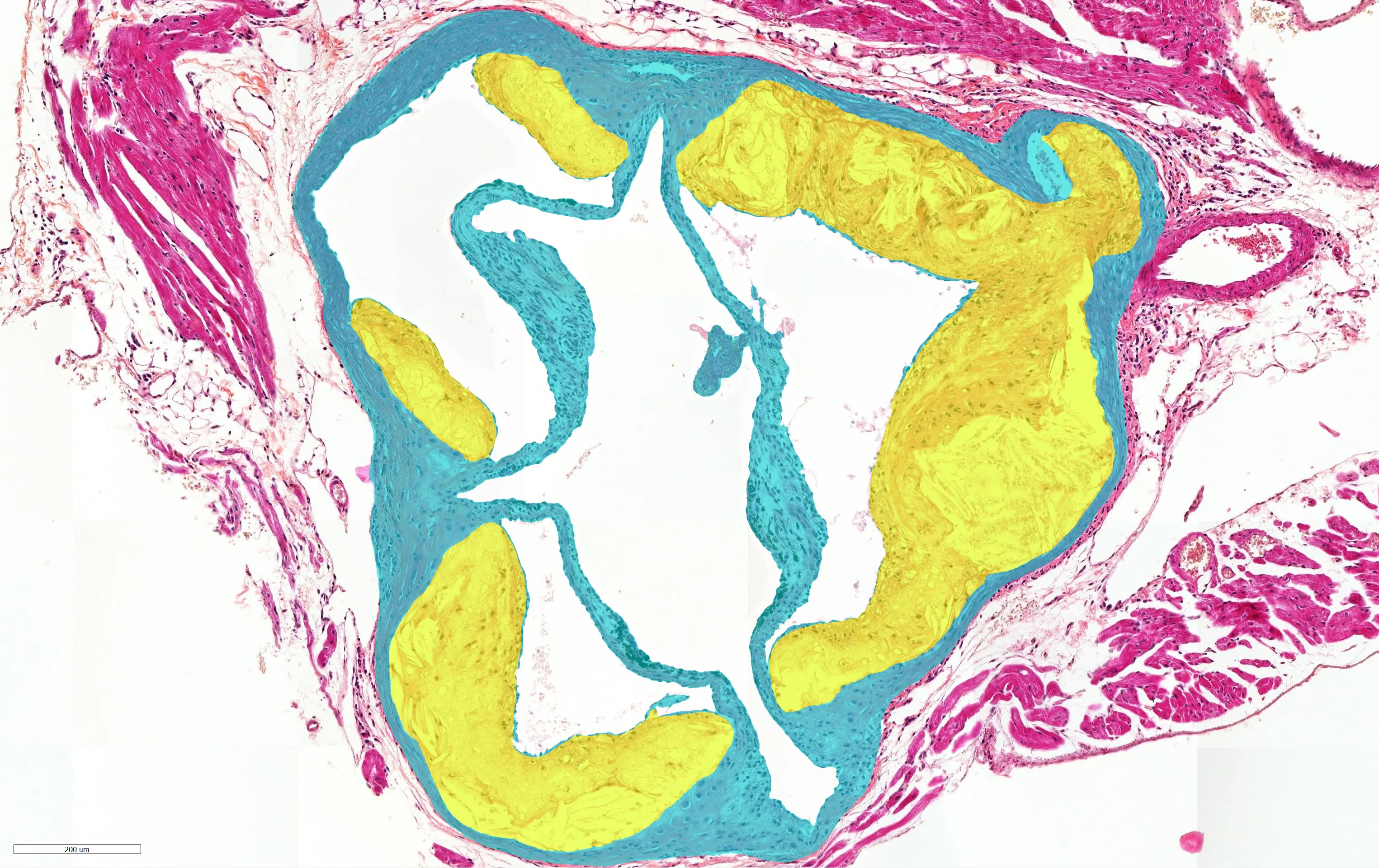 AI read-out of atherosclerosis tissue