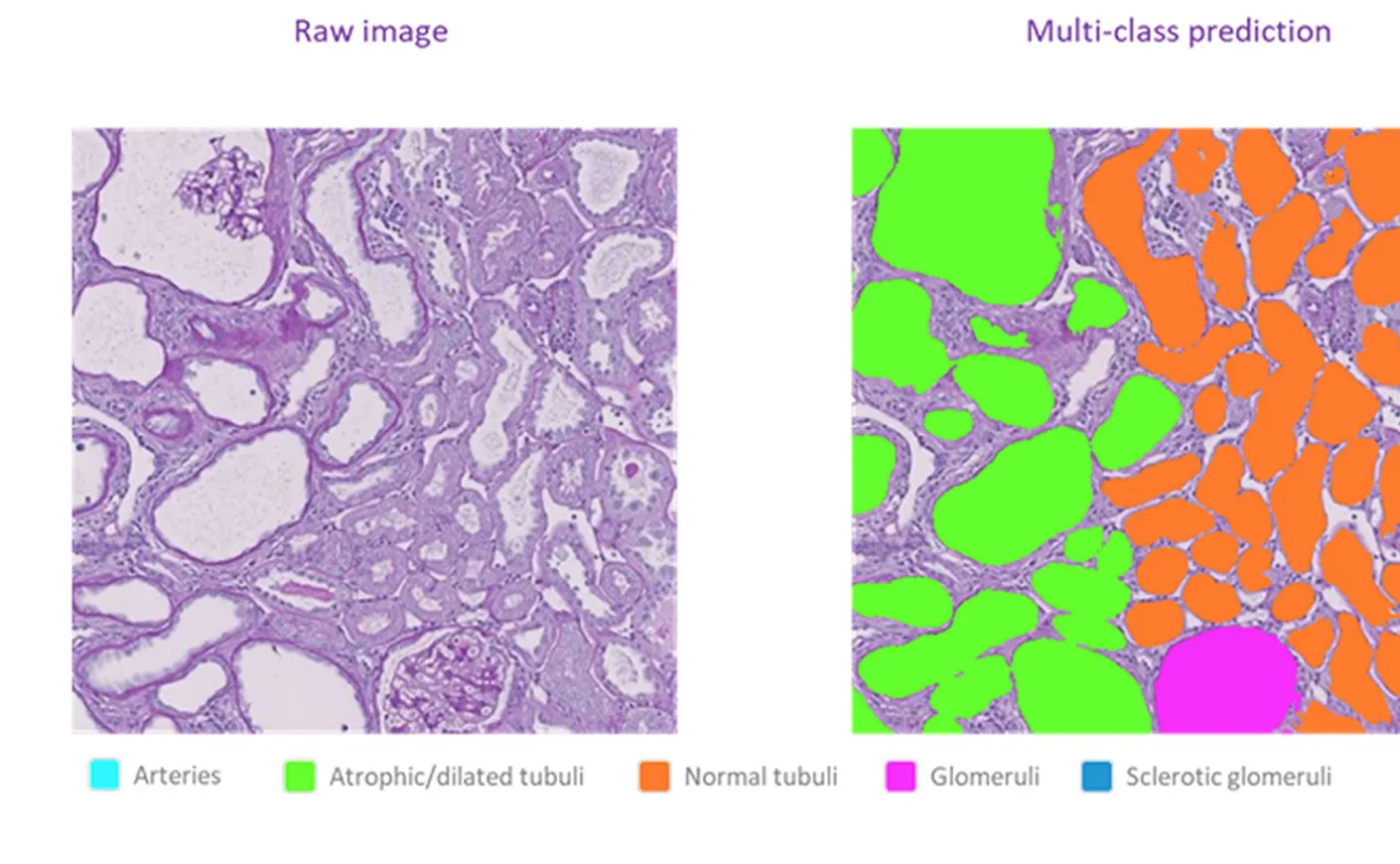 Figure from the published study: a raw PAS-stained kidney section beside Aiosyn's multi-class AI prediction, with a legend for arteries, tubuli, and glomeruli.