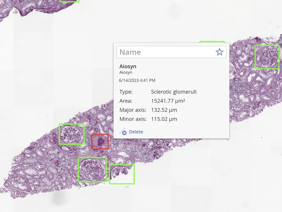 Aiosyn's NephroPath GlomeruCount introduces AI-powered kidney image analysis to Sectra Amplifier Marketplace