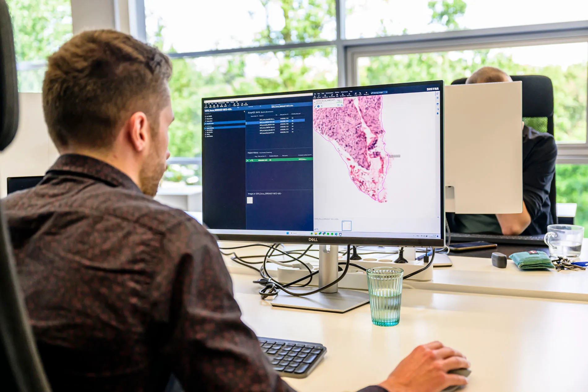 AI engineer inspecting the quality of a digital histology slide opened from the Sectra viewer. A visible artifact, an out-of-focus area, has been identified and segmented by automated QC solution AiosynQC.