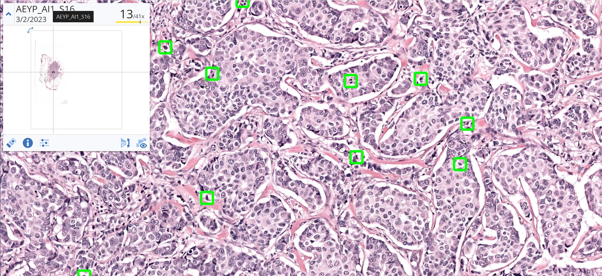 Deep-learning breast cancer mitosis detection output by Aiosyn Mitosis Breast in an H&amp;E histology digital slide at medium magnification